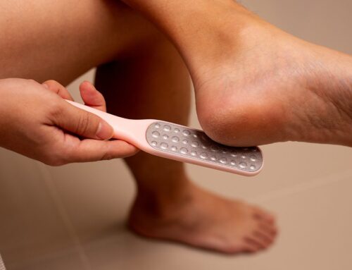 Hiperqueratosis localizada (Callos)